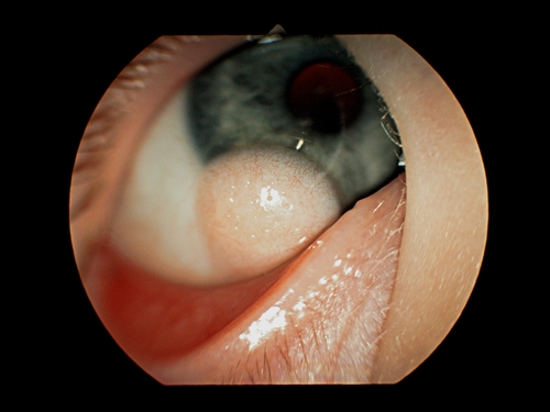 Cysta_dermoidalna_rogówki_i_spojówki_2.jpg