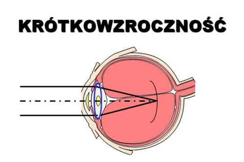 Krótkowzrocznosc