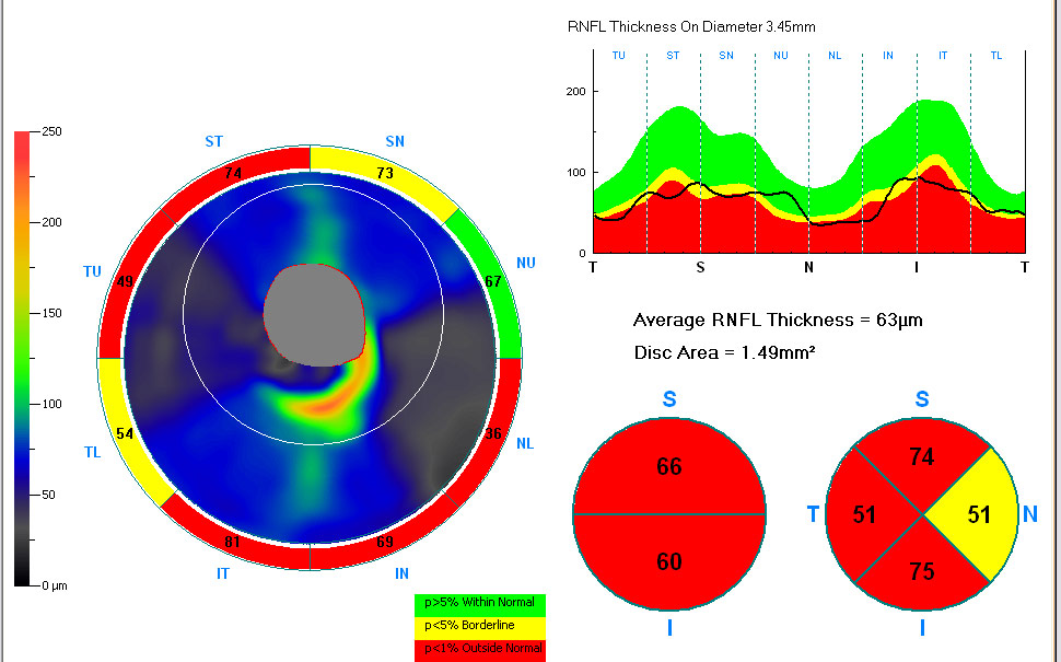 OCT RNFL II