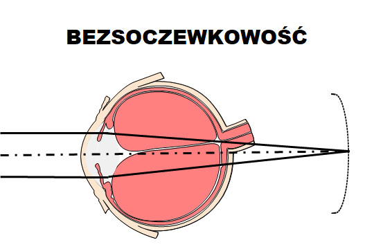 bezsoczewkowosc