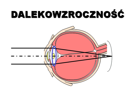 dalekowzrocznosc